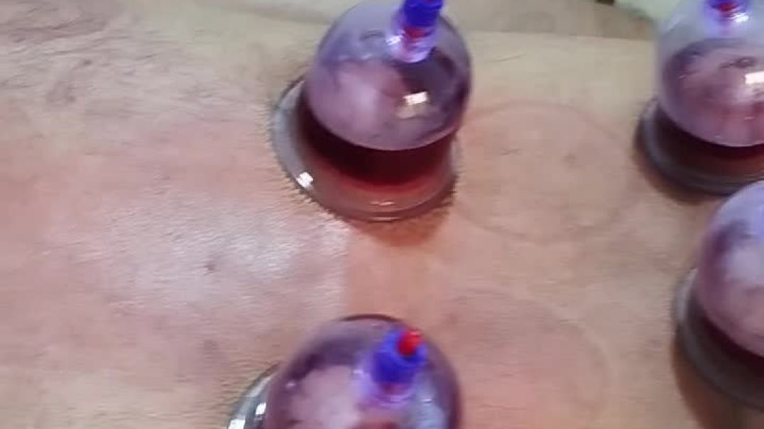 الحجامة الطبية الحديتة